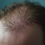 Haarausfall erkennen: Wann handeln nötig ist